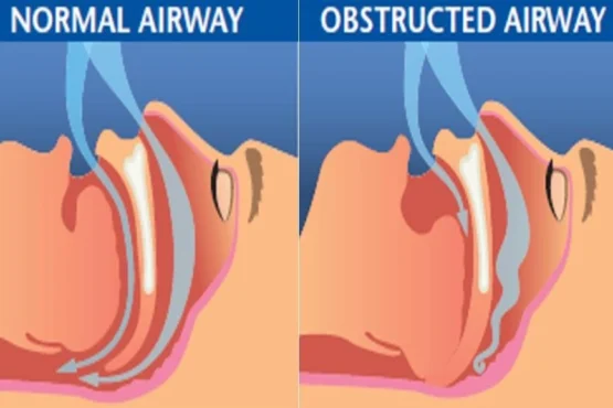 Obstructive Sleep Apnea